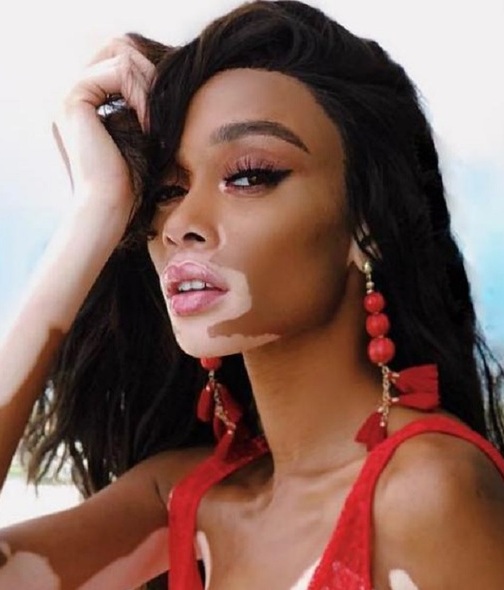 Winnie Harlow, la modelo con vitiligo que revolucionó la moda (Foto: Instagram)