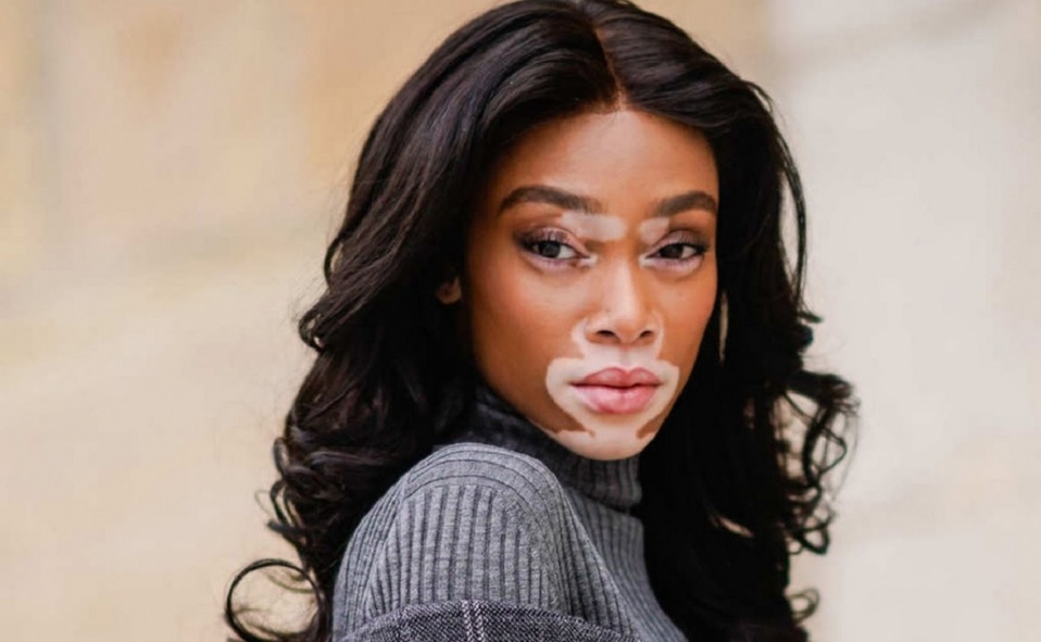 Winnie Harlow, la modelo con vitiligo que revolucionó la moda (Foto: Instagram)