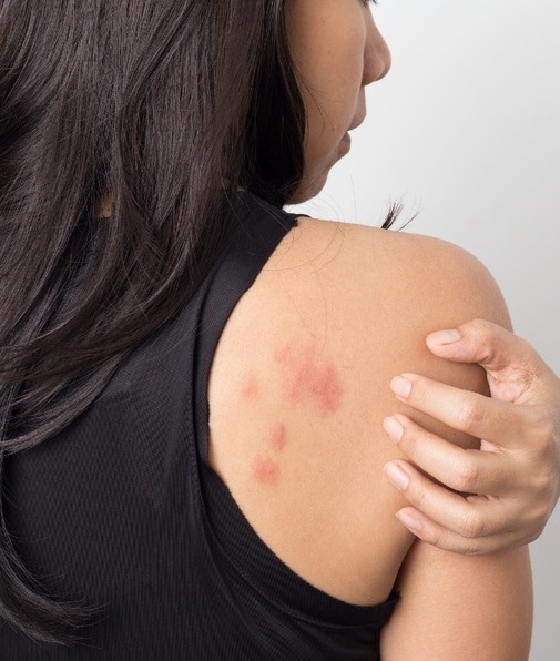 Es importante prestar atención a los síntomas en la piel ya que existen manifestaciones asociados al coronavirus (Foto: Getty Images)