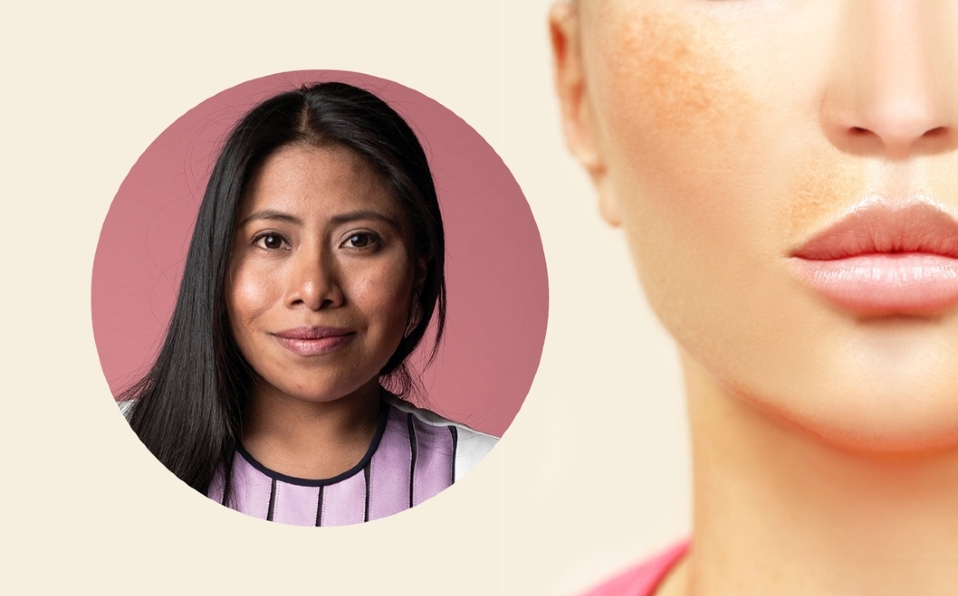 Qué es el melasma: síntomas, causas, tratamiento (Foto: Getty Images)