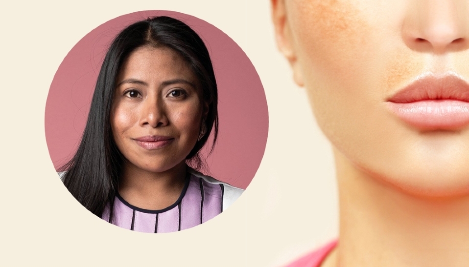 Qué es el melasma: síntomas, causas, tratamiento (Foto: Getty Images)