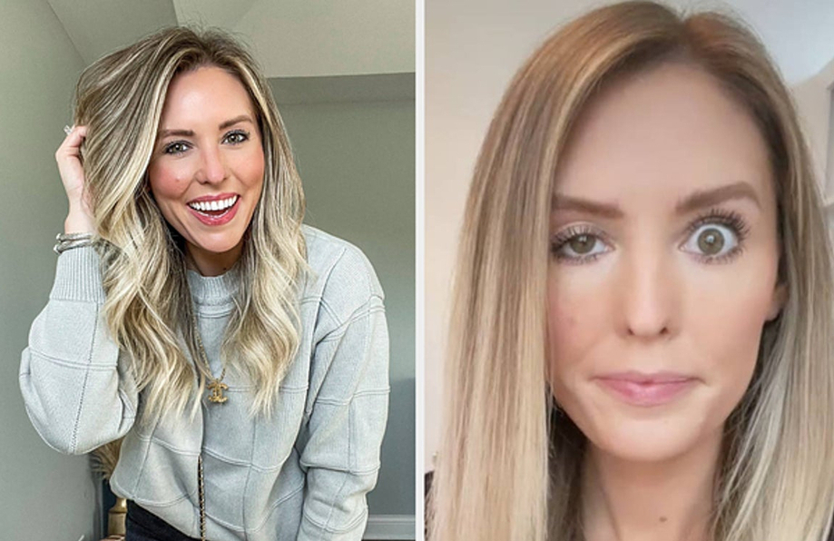 Consecuencias del bótox: Influencer se inyecta y se le cae el párpado (Foto: Instagram)