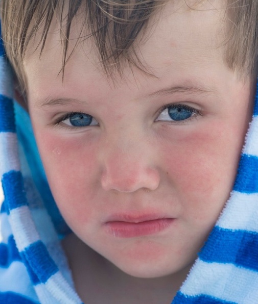Hasta el 85% de casos de dermatitis atópica se presenta en el primer año de vida (Foto: Getty Imagen).