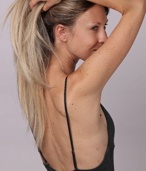 El melanoma es de los más diagnosticados en adultos jóvenes, particularmente en mujeres (Foto: Shutterstock).