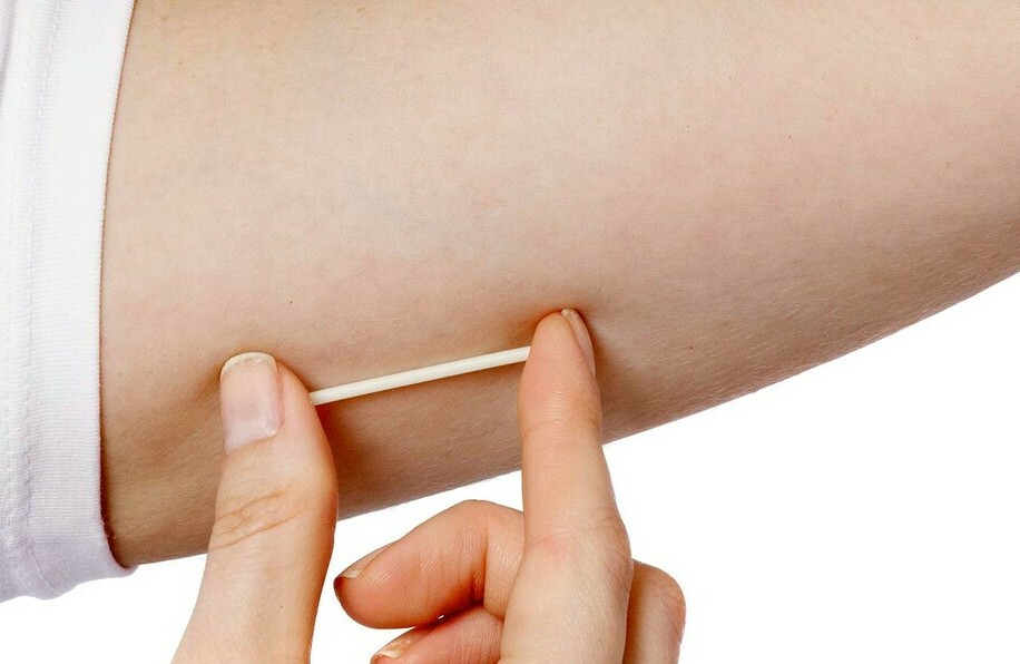 ¿Qué tan efectivo es el implante anticonceptivo? (Foto:  Instagram)