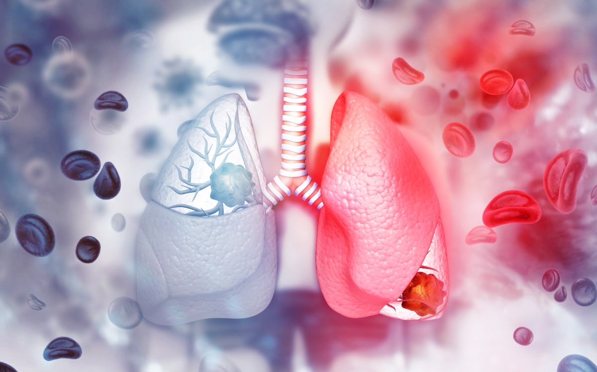 Cáncer de pulmón y covid: Síntomas que pueden confundirse (Foto: Getty Images)