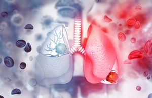 Cáncer de pulmón y covid: Síntomas que pueden confundirse (Foto: Getty Images)
