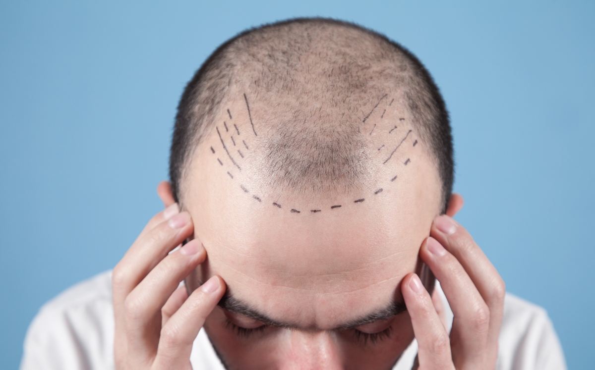 Trasplante de cabello: Todo lo que debes saber (Foto: Getty Images)