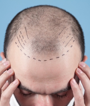Trasplante de cabello: Todo lo que debes saber (Foto: Getty Images)