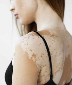 Este es el súper alimento que combate el vitiligo, según estudio (Foto: Getty Images)