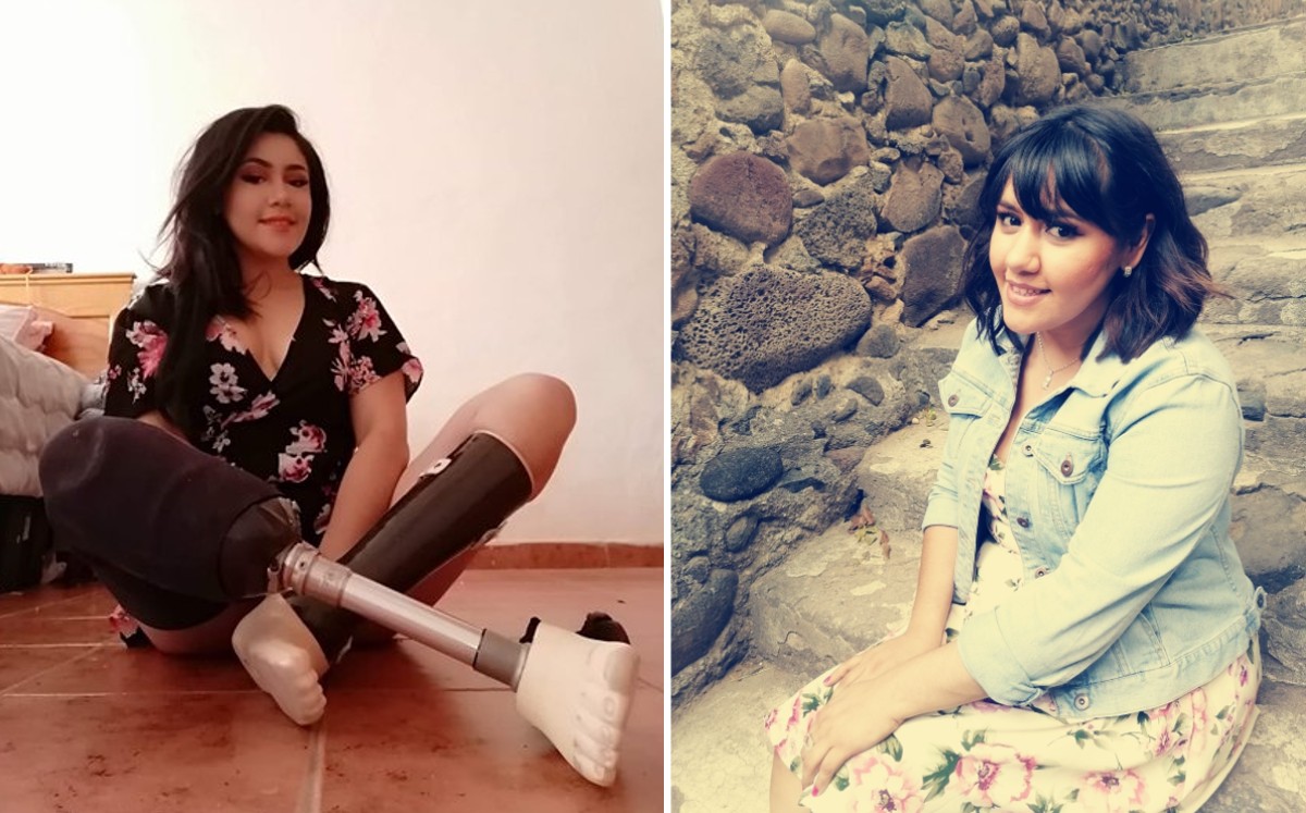 Ella es Vanessa Dib, la mujer a la que el IMSS le apuntó las piernas por negligencia médica.