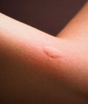 Picaduras de mosquitos