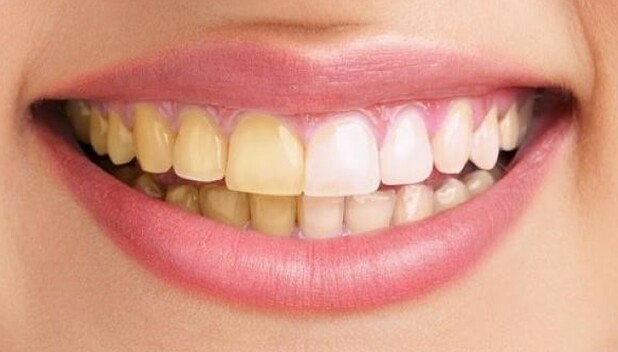 Dientes amarillos: Cómo blanquear tu sonrisa sin arriesgar tu salud (Foto: Pinterest)
