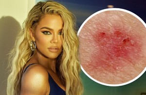 Melanoma: 5 claves para identificar el cáncer de piel de Khloé Kardashian