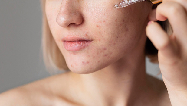 Si tienes acné estos son los ingredientes que no debes de usar en tu Skincare/Foto: Cortesía