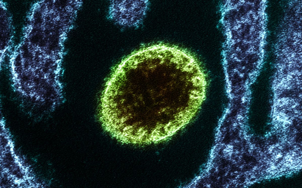 Nipah: ¿Qué es y cuáles son los síntomas del virus en la India? (Foto: Getty)