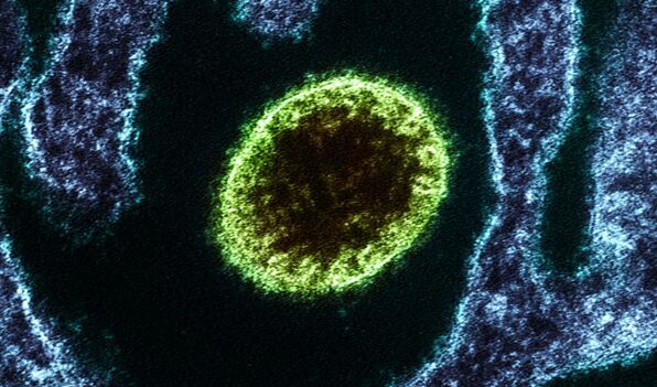 Nipah: ¿Qué es y cuáles son los síntomas del virus en la India? (Foto: Getty)