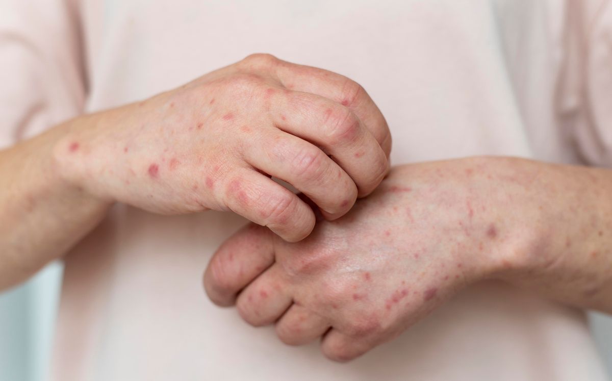 Lupus: ¿Por qué las mujeres lo padecen más que los hombres? (Freepik)