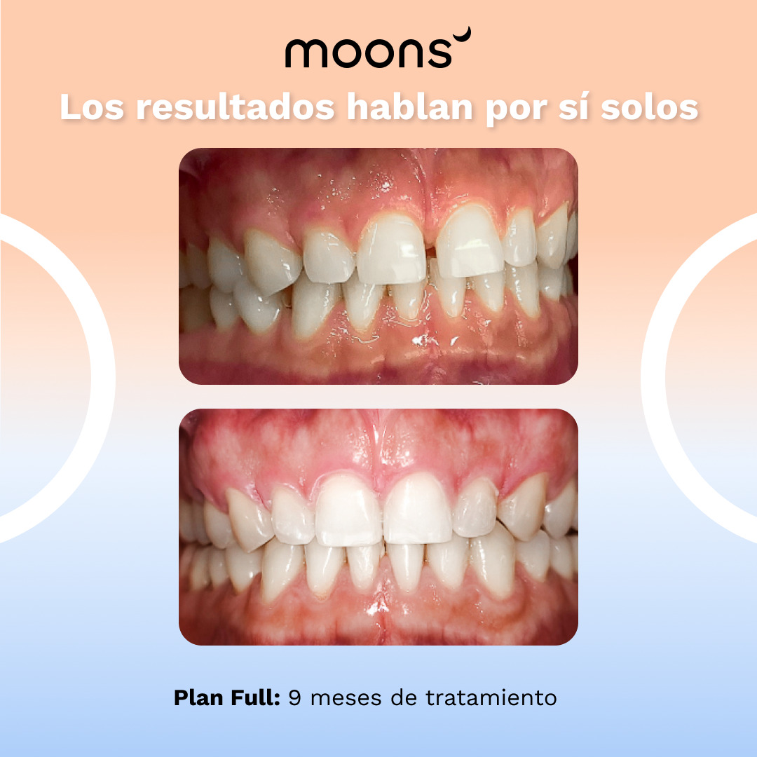 Los resultados de Moons son gracias a un tratamiento eficiente y accesible (Cortesía)