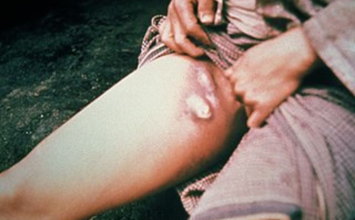Así se ve la peste bubónica (Wikipedia)