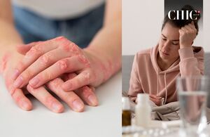 OMS considera alerta mundial ante el aumento de casos de virus mpox (Freepik)