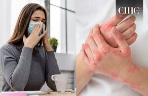 ¿El peligro que corremos con el virus mpox es mayor al del COVID-19? (Freepik)
