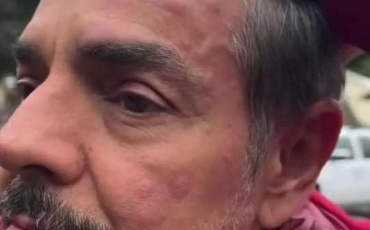 Hinchazón en el rostro de Eugenio Derbez (Instagram)
