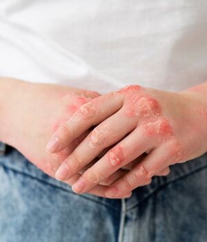 Psoriasis y los hábitos que la empeoran (Freepik)