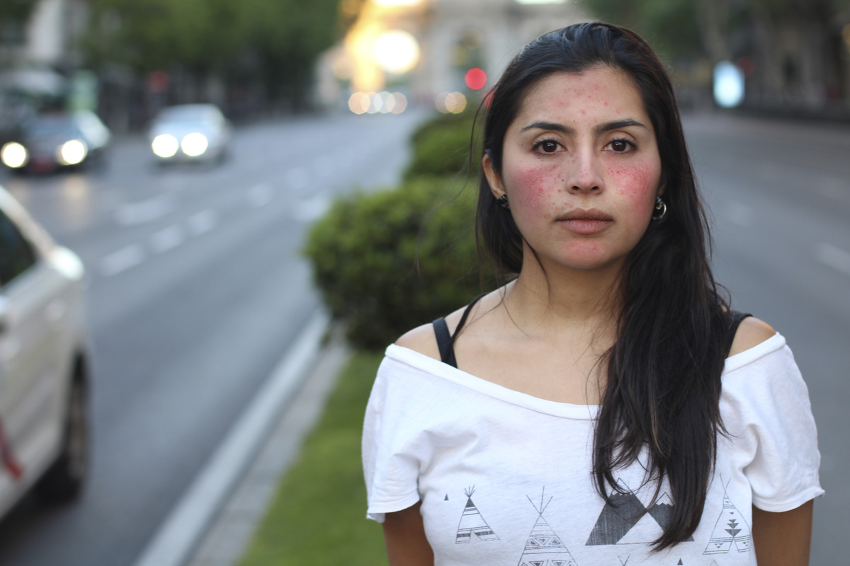 La rosácea es una enfermedad inflamatoria de la piel (Foto: Cortesía)
