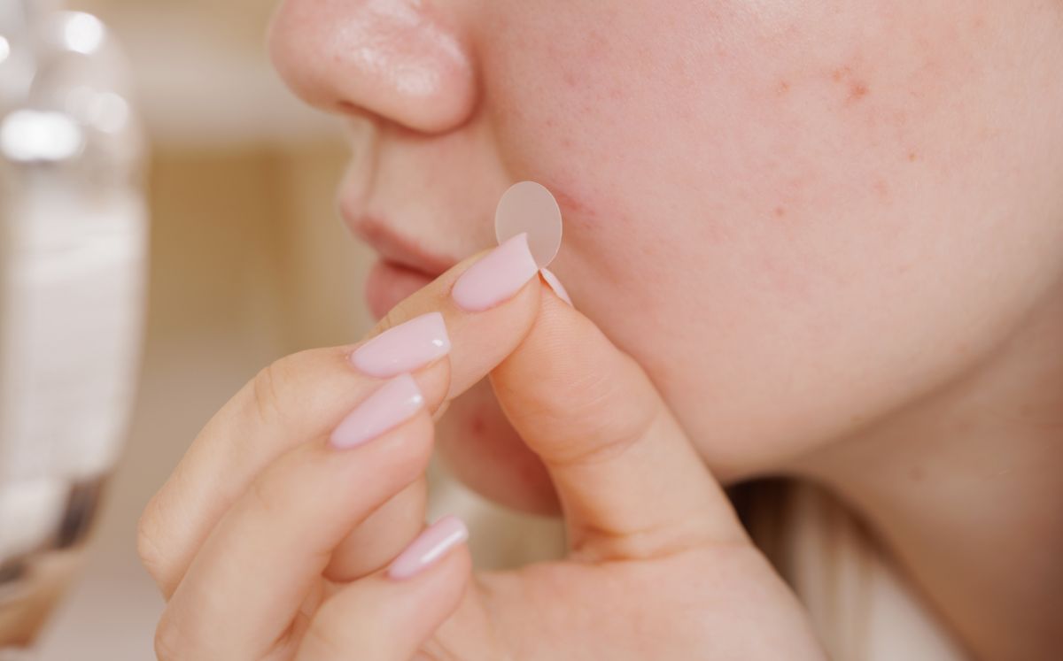 Parches para acné: ¿qué tan efectivos son? (Foto: Getty)