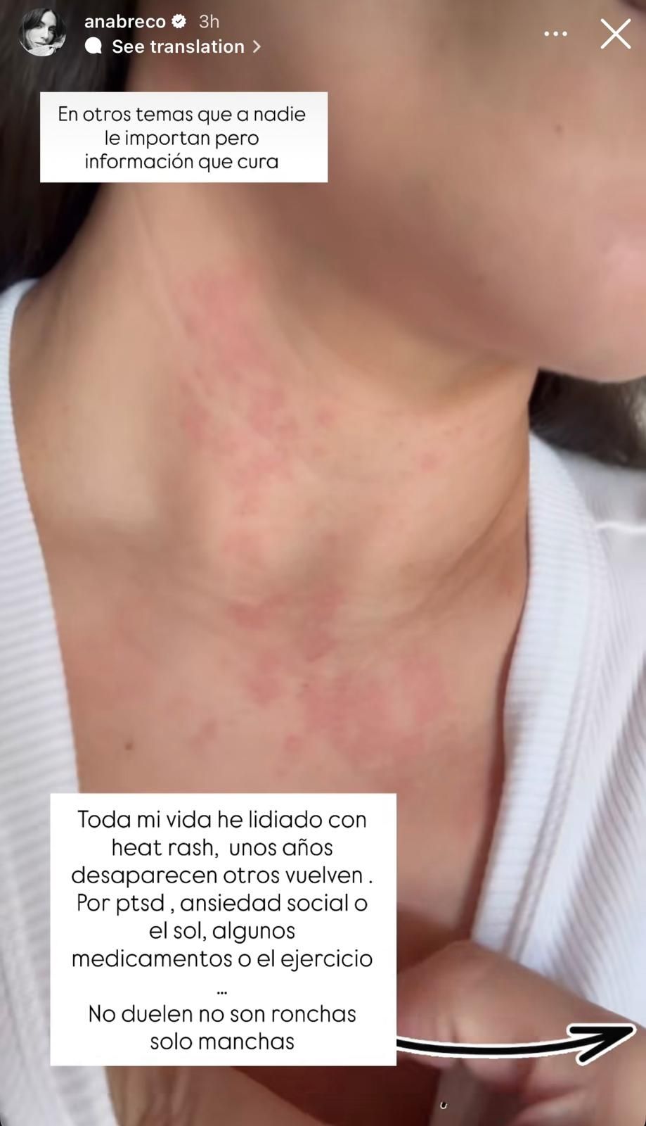 Heat rash de Ana Brenda Contreras (Instagram)