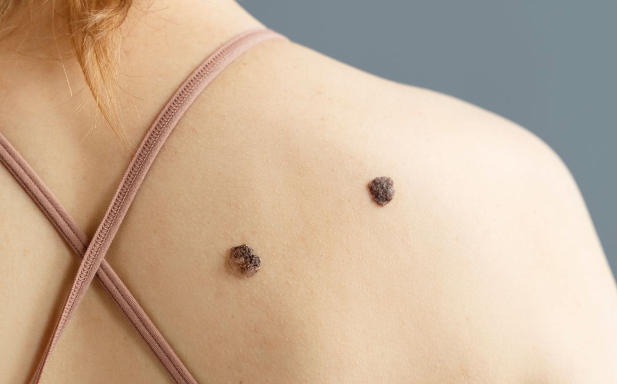 Todo sobre el cáncer de piel (Freepik)