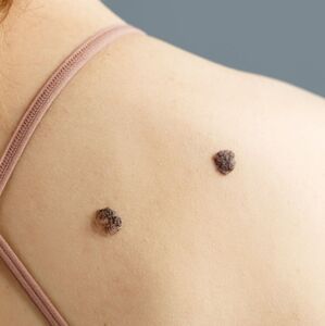 Todo sobre el cáncer de piel (Freepik)