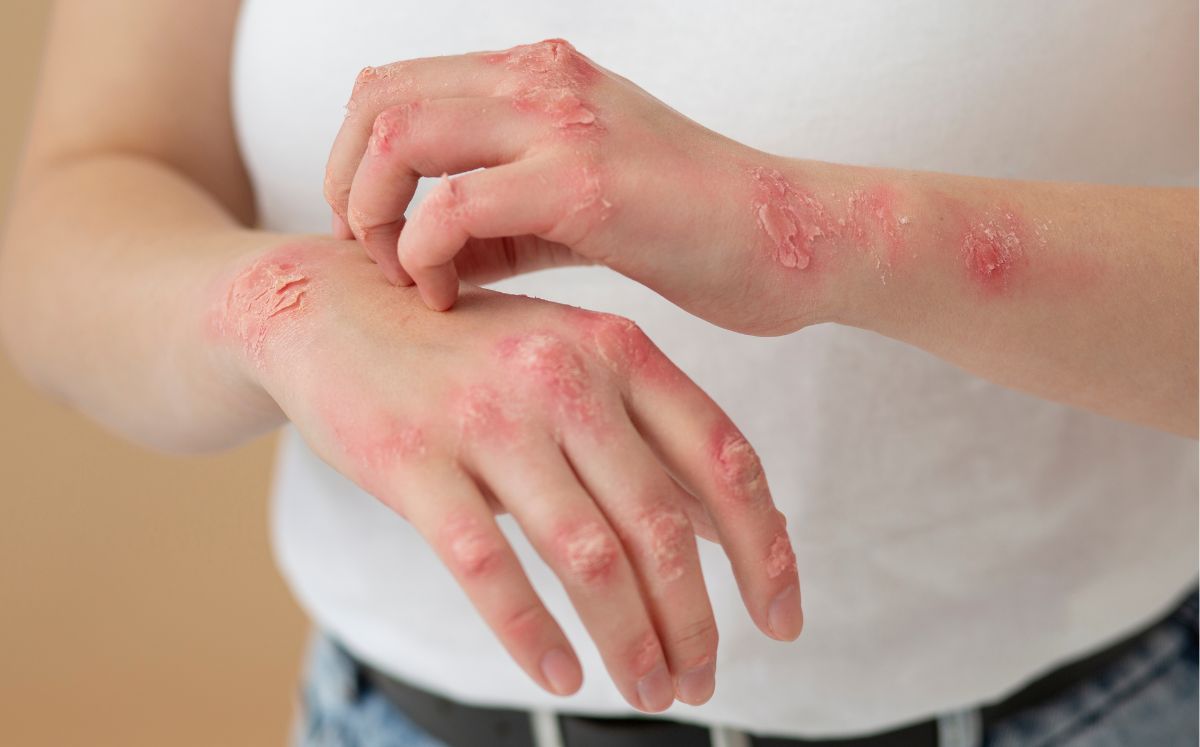 Conoce los síntomas del sarampión, cómo se contagia y por qué sigue siendo una amenaza (Freepik)