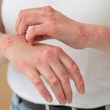 Conoce los síntomas del sarampión, cómo se contagia y por qué sigue siendo una amenaza (Freepik)