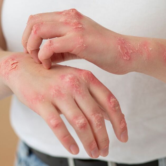 Conoce los síntomas del sarampión, cómo se contagia y por qué sigue siendo una amenaza (Freepik)