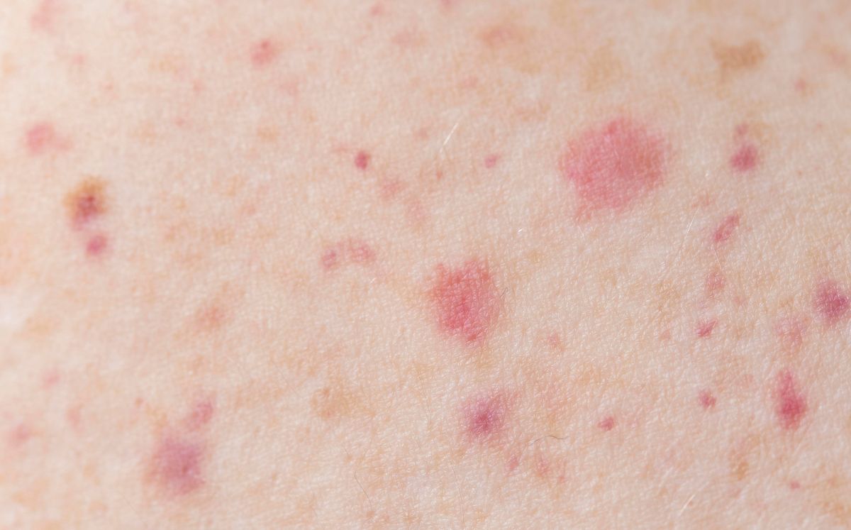 Estos son los síntomas del sarampión, cómo evolucionan y cuándo debes acudir al médico ante una posible infección (Freepik)