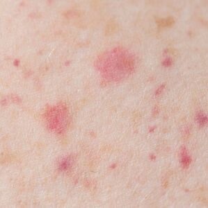 Estos son los síntomas del sarampión, cómo evolucionan y cuándo debes acudir al médico ante una posible infección (Freepik)