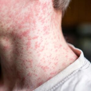 Conoce quiénes no deben vacunarse contra el sarampión, pese al rebrote, y qué hacer en situaciones especiales (Getty Images)