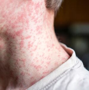 Conoce quiénes no deben vacunarse contra el sarampión, pese al rebrote, y qué hacer en situaciones especiales (Getty Images)