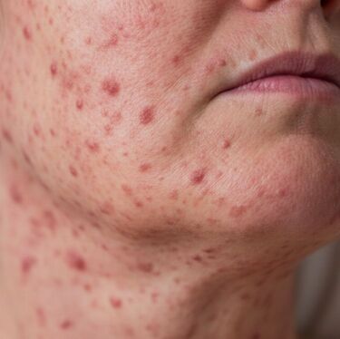Conoce qué es el sarampión, sus síntomas y quiénes corren mayor riesgo ante el aumento de casos en 2026 (IA)