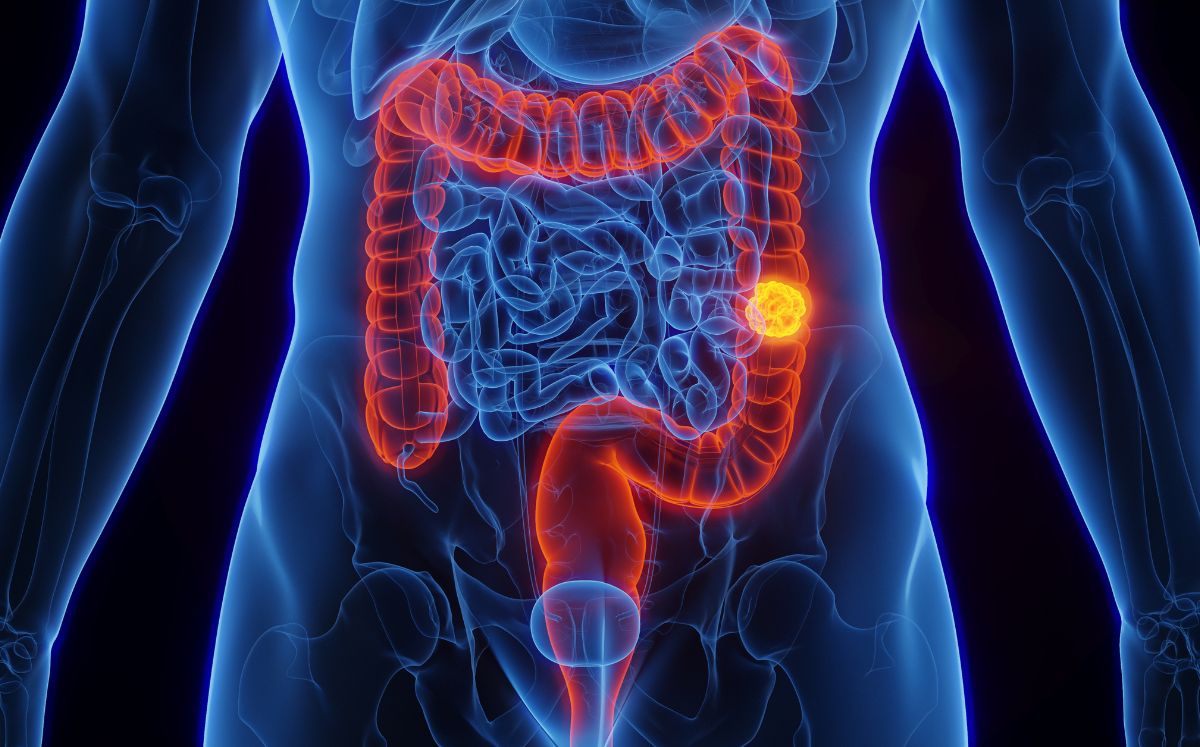 Riesgo de cáncer colorrectal por consumo de hoy dogs (Getty Images)