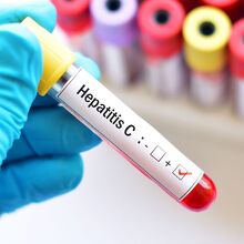 Hepatitis C: Señales de alerta, pruebas y tratamiento (Foto: Getty)