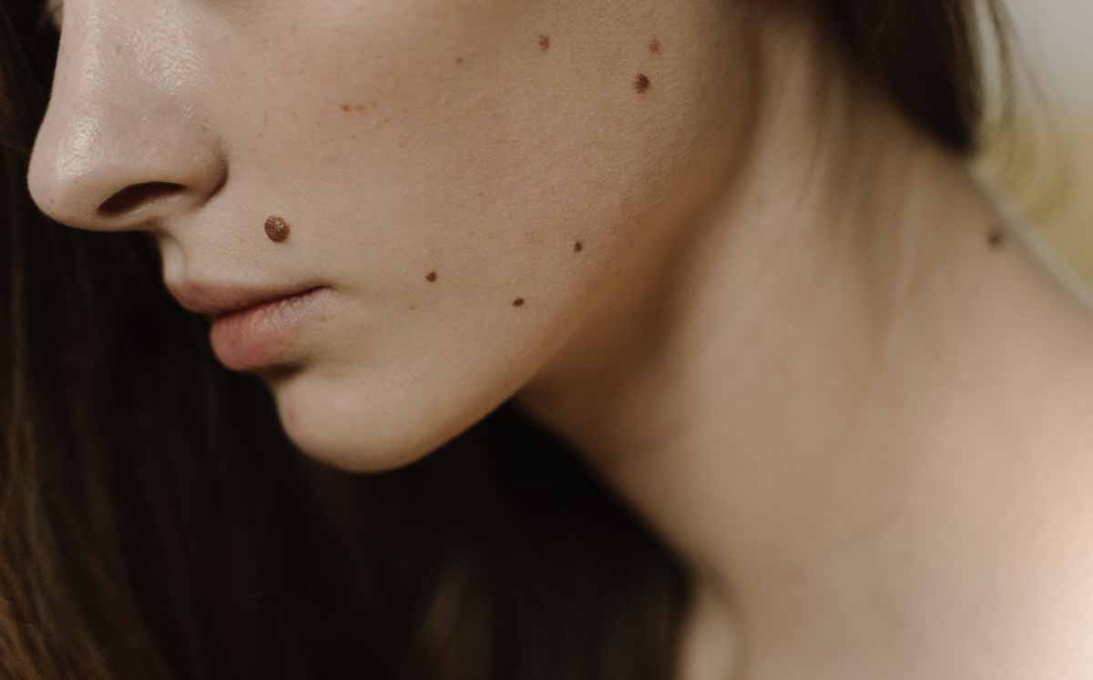 La melanomancia es una tradición oriental de interpretación de los lunares. (Fotos: Pexels)